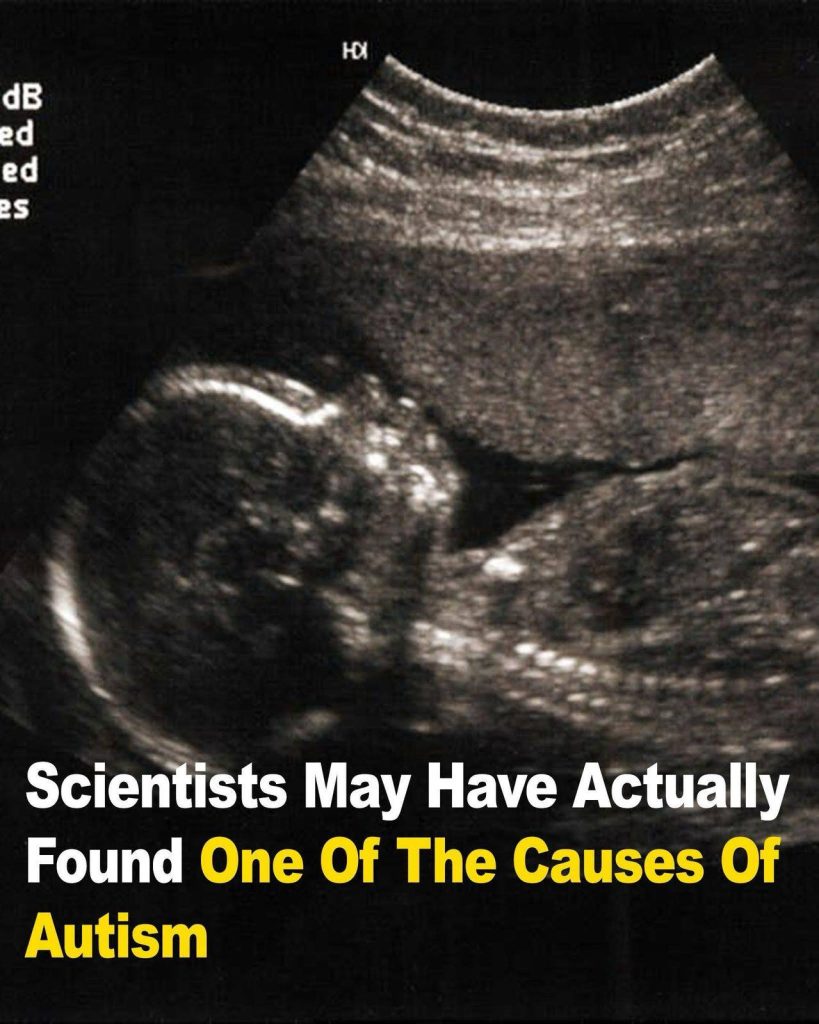 Scientists May Have Actually Found One Of The Causes Of Autism
