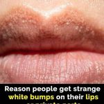 Reason behind strange white bumps found on your private parts