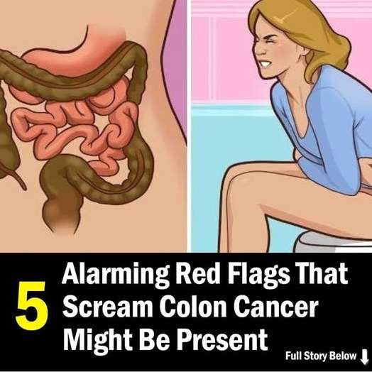 5 Early Signs of Colon Cancer You Shouldn’t Ignore