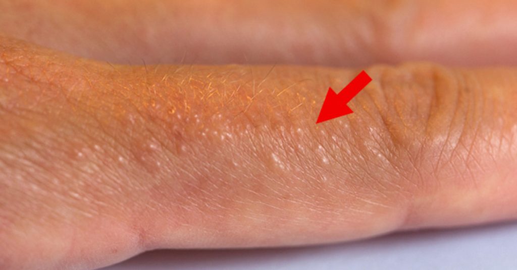 If You See These Painful Red Bumps, You May Have Dyshidrotic Eczema