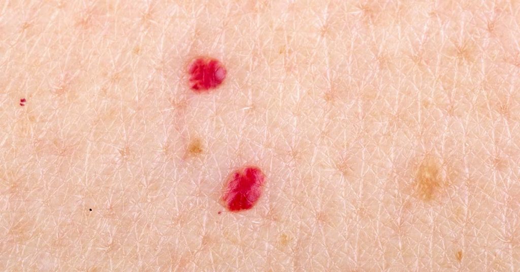 11 Reasons Why You Have Red Dots On Your Skin
