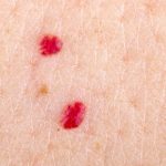 11 Reasons Why You Have Red Dots On Your Skin