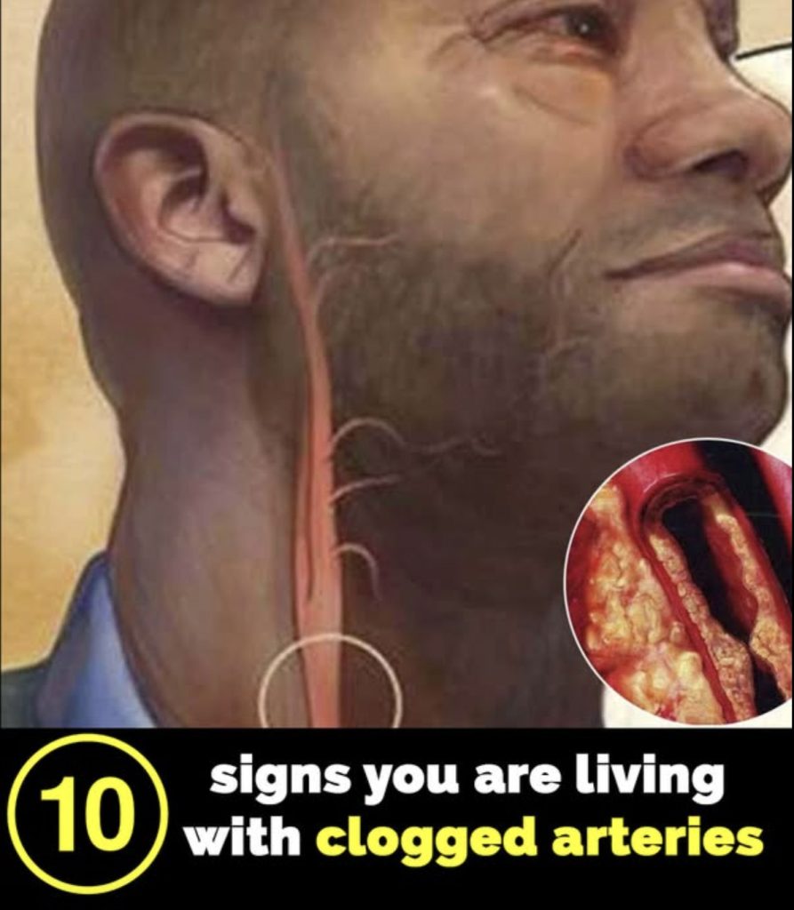 10 signs your arteries might be clogged