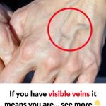 When to Worry About Veins That Appear Out of Nowhere