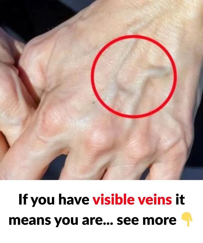When to Worry About Veins That Appear Out of Nowhere