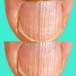 Rippled Fingernails Reveal Secrets Of Possible Disease