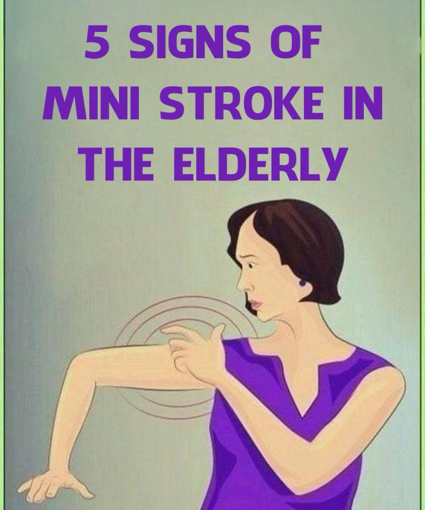 Mini Stroke in the Elderly: Common and Unusual Symptoms