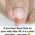 Nail Ridges After 40 Aren’t Just a Cosmetic Issue—Here’s the Hidden Message Behind Them