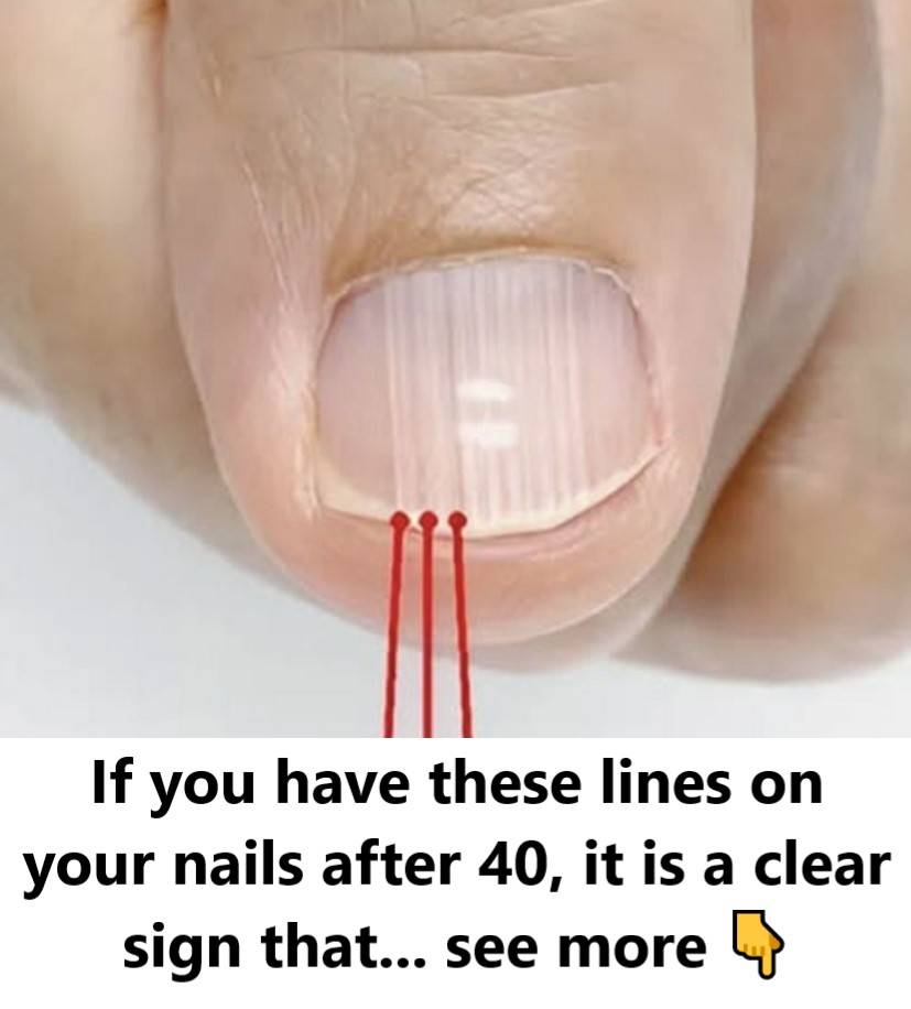 Nail Ridges After 40 Aren’t Just a Cosmetic Issue—Here’s the Hidden Message Behind Them