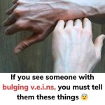 Why Are My Veins Suddenly Bulging and Visible?