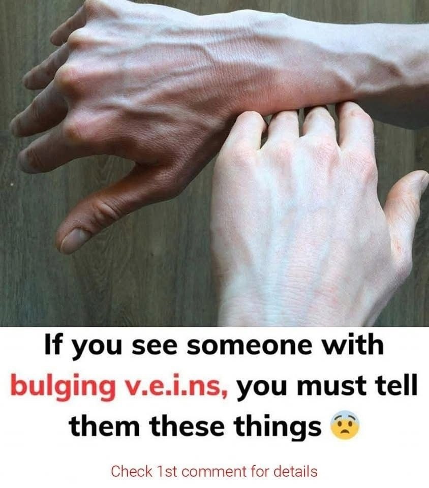 Why Are My Veins Suddenly Bulging and Visible?