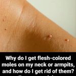 Why do I get flesh-colored moles on my neck or armpits, and how do I get rid of them? Experts explain.