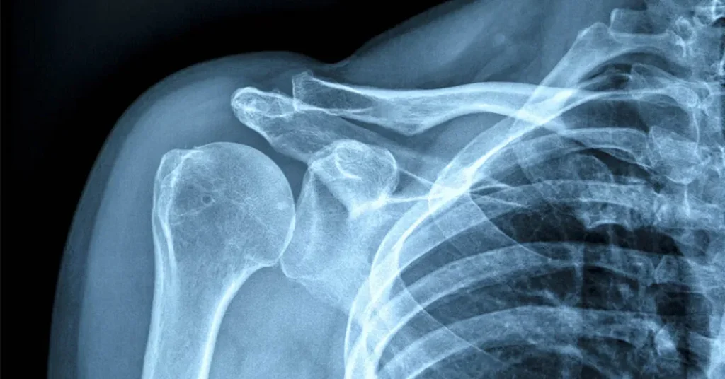 Researchers Create Injectable Hydrogel to Boost Bone Strength