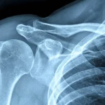 Researchers Create Injectable Hydrogel to Boost Bone Strength