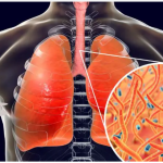 How to Naturally Clear Phlegm and Mucus from Chest and Throat