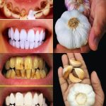 Improve Your Oral Health Naturally with Garlic