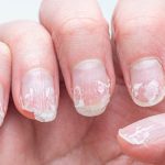Rippled fingernails reveal secrets of possible disease