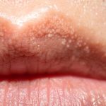 What Are the White Bumps on Your Private Parts — and Should You Be Worried?