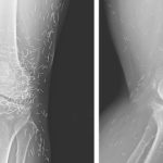 Doctors find “gold mine” in woman’s knees