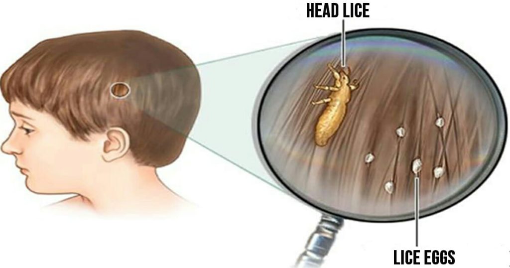 Head lice: How to get rid of them and stop them coming back