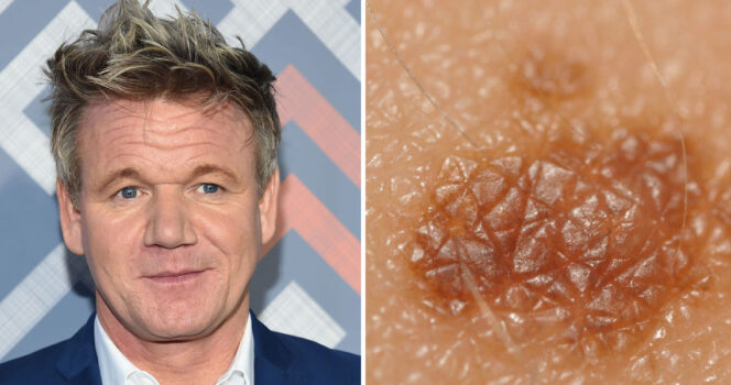 Gordon Ramsay issues health warning after surgery