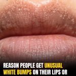 The Cause Of The Odd White Pimples On Your Your Body