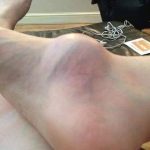 For years, a woman’s foot swelled, and she finally went to the doctor to find out why.