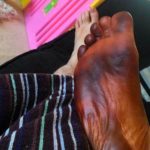 He was terribly scared when he woke up one morning with brown-black feet.