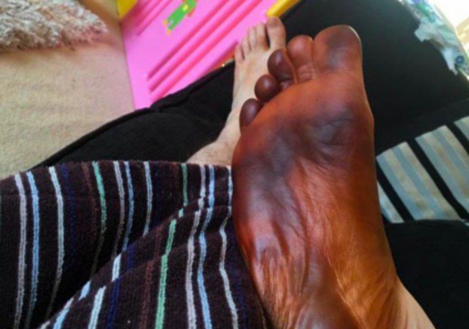 He was terribly scared when he woke up one morning with brown-black feet.