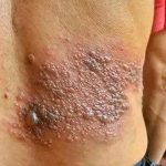 Young woman dies at the hands of her…See moreIt was itching his body, he thought it was an allergy, but a tough diagnosis… See more