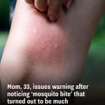 Mom, 33, issues warning after noticing ‘mosquito bite’ that turned out to be much more sinister