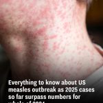 Everything to know about US measles outbreak as 2025 cases so far surpass numbers for whole of 2024