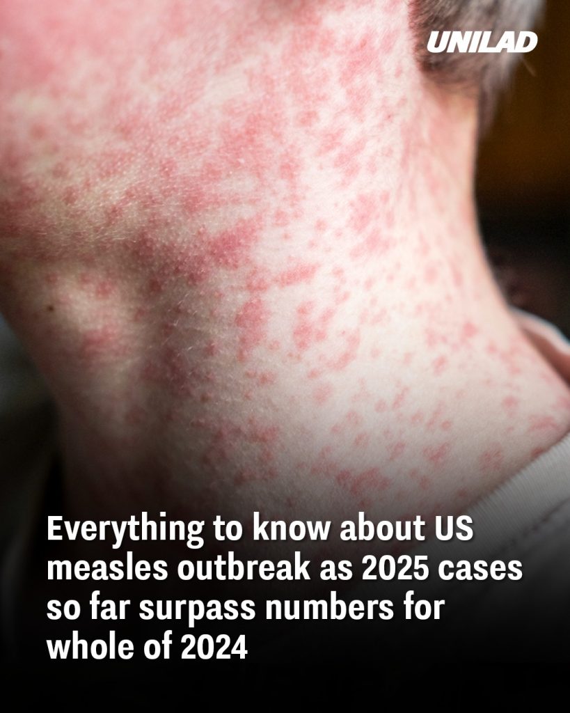 Everything to know about US measles outbreak as 2025 cases so far surpass numbers for whole of 2024