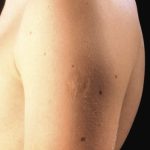 Smallpox vaccine scars: What they look like and why