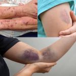 BE CAREFUL, if you get these bruises on your body, it means you have…