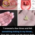 Here’s what you need to know about tonsil stones – the weird pimple-like growths in your throat