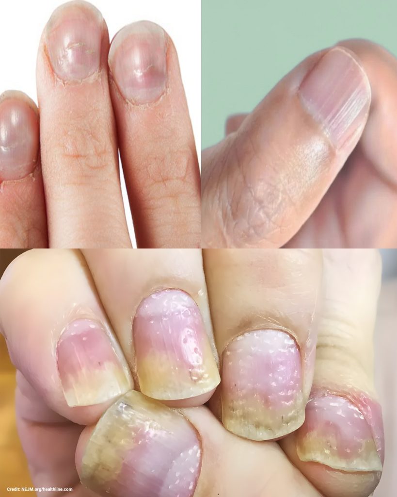 Observe your nails to detect health issues